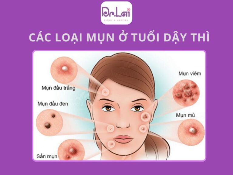 Mụn trứng cá tuổi dậy thì