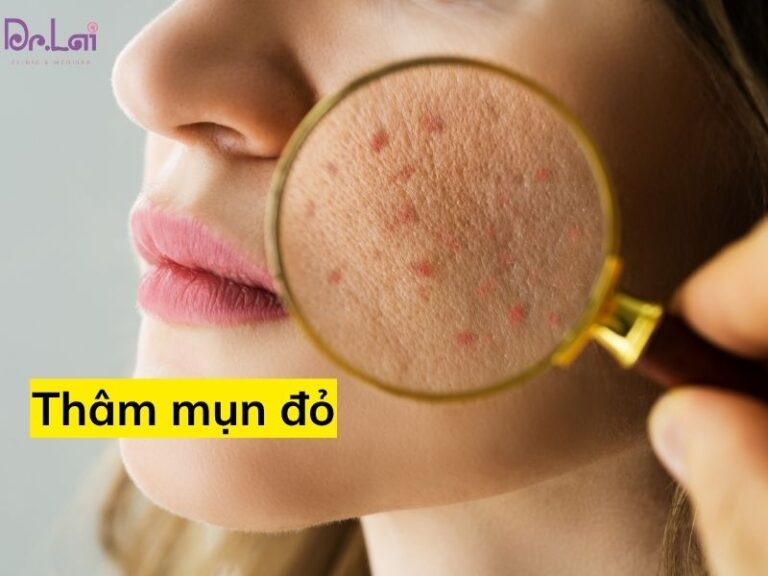 mụn hết nhưng vẫn để lại thâm